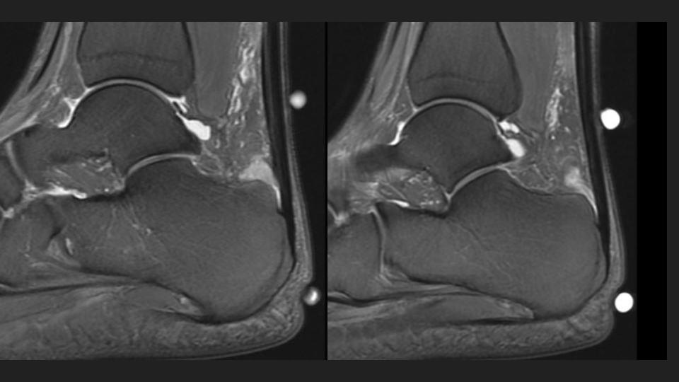 Figure 4 for case retrocalcaneal bursa ( RID3217 )